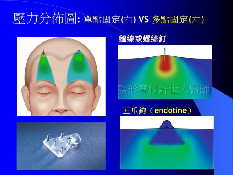Endoscopic Forehead Lif-分佈圖 Endoscopic Forehead Lif 分佈圖