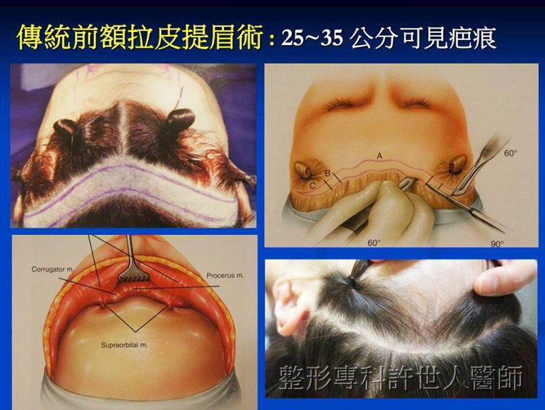 傳統拉皮提眉-1 傳統拉皮提眉 1