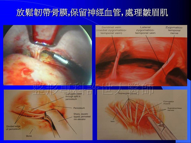 內視鏡提眉術設備和工具-2 內視鏡提眉術設備和工具 2