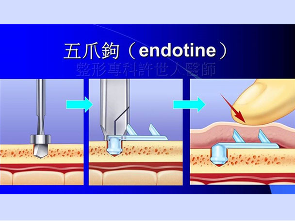 內視鏡提眉術設備和工具-4-1 內視鏡提眉術設備和工具 4 1