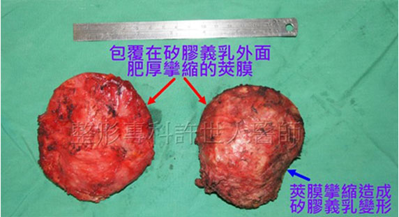 包覆在矽膠義乳外面 2021 1