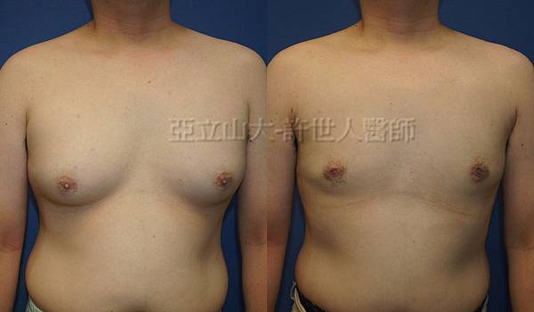 男性女乳症 許世人醫師案例分享 01