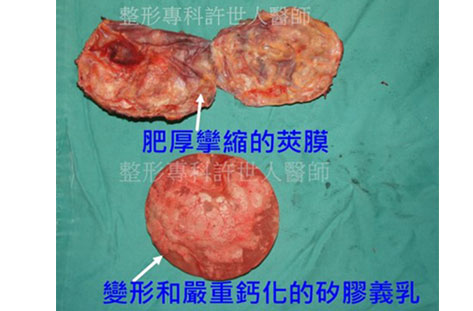 肥厚攣縮的莢膜 2021 1