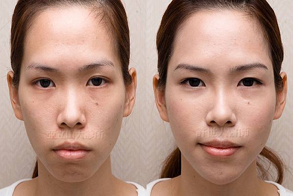 自體脂肪全臉雕塑 許世人醫師案例分享 02