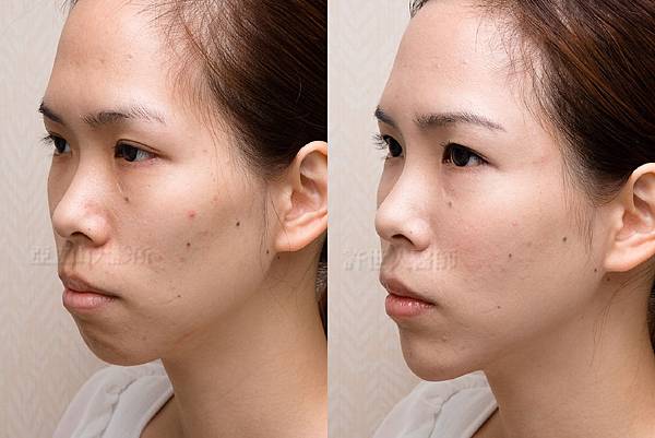 自體脂肪全臉雕塑 許世人醫師案例分享 03