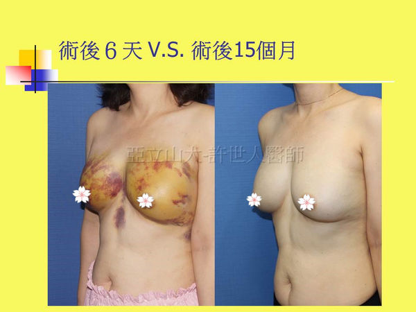 拯救矽膠假體隆乳失敗的新方法—SIEF假體脂肪置換隆乳術