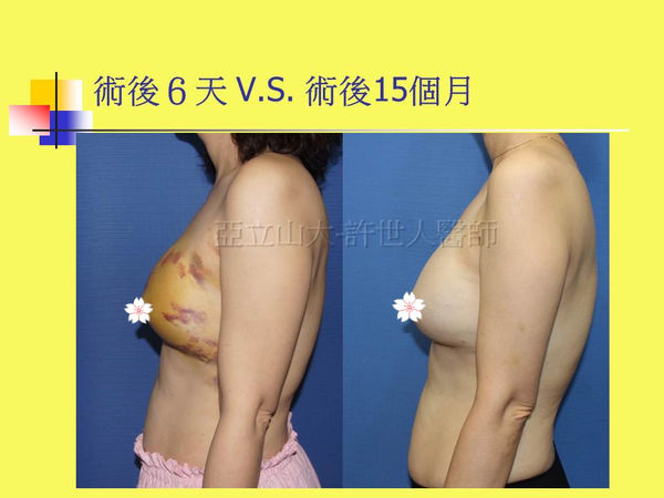 拯救矽膠假體隆乳失敗的新方法—SIEF假體脂肪置換隆乳術