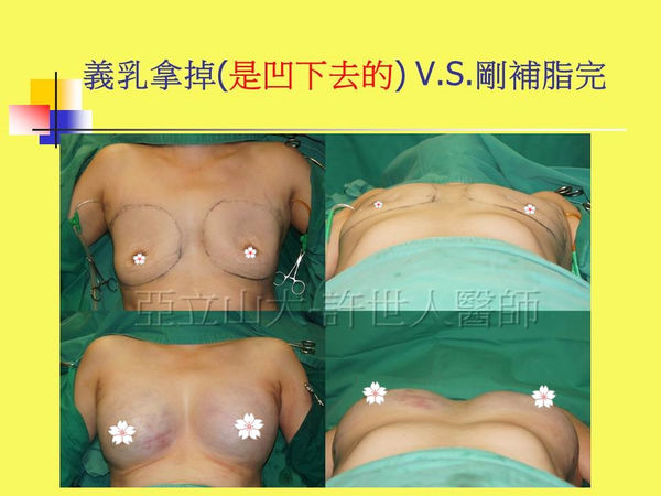 拯救矽膠假體隆乳失敗的新方法—SIEF假體脂肪置換隆乳術