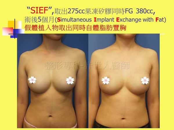 拯救矽膠假體隆乳失敗的新方法—SIEF假體脂肪置換隆乳術