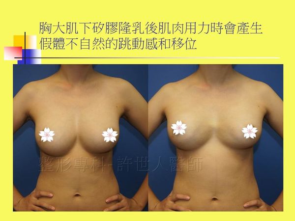 拯救矽膠假體隆乳失敗的新方法—SIEF假體脂肪置換隆乳術