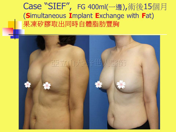 拯救矽膠假體隆乳失敗的新方法—SIEF假體脂肪置換隆乳術
