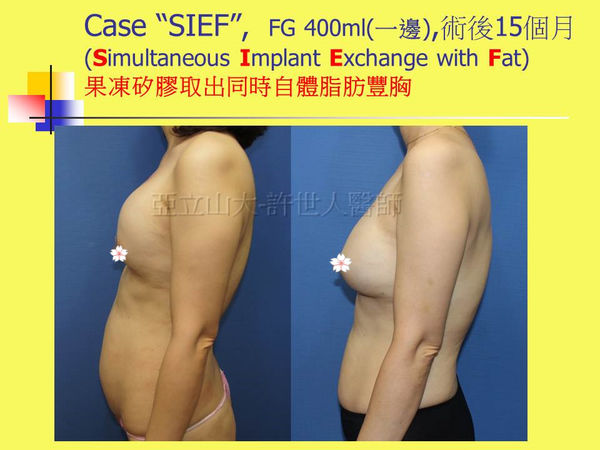 拯救矽膠假體隆乳失敗的新方法—SIEF假體脂肪置換隆乳術