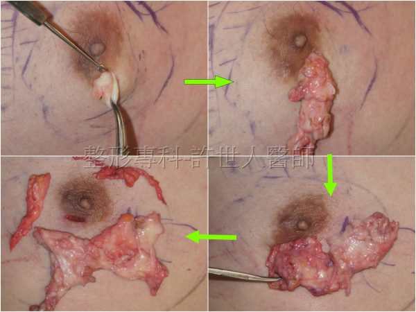 男性女乳症金蟬脫殼式的乳房腺體切除術 男性女乳症"金蟬脫殼式"的乳房腺體切除術