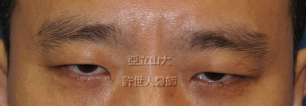 內視鏡五爪鈎前額拉皮提眉術 7 83