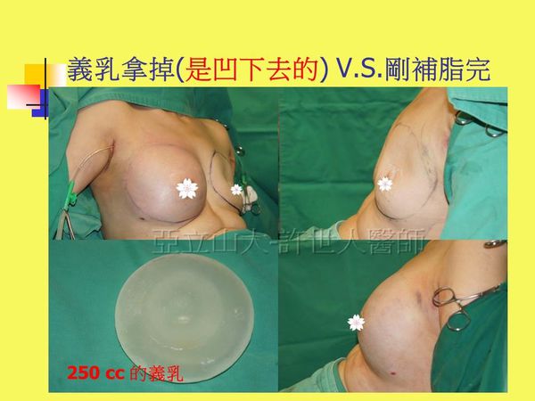 SIEF 自體脂肪隆乳豐胸