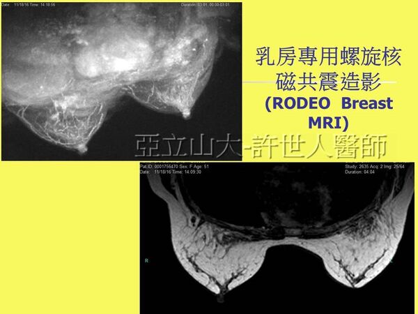 SIEF 自體脂肪隆乳豐胸