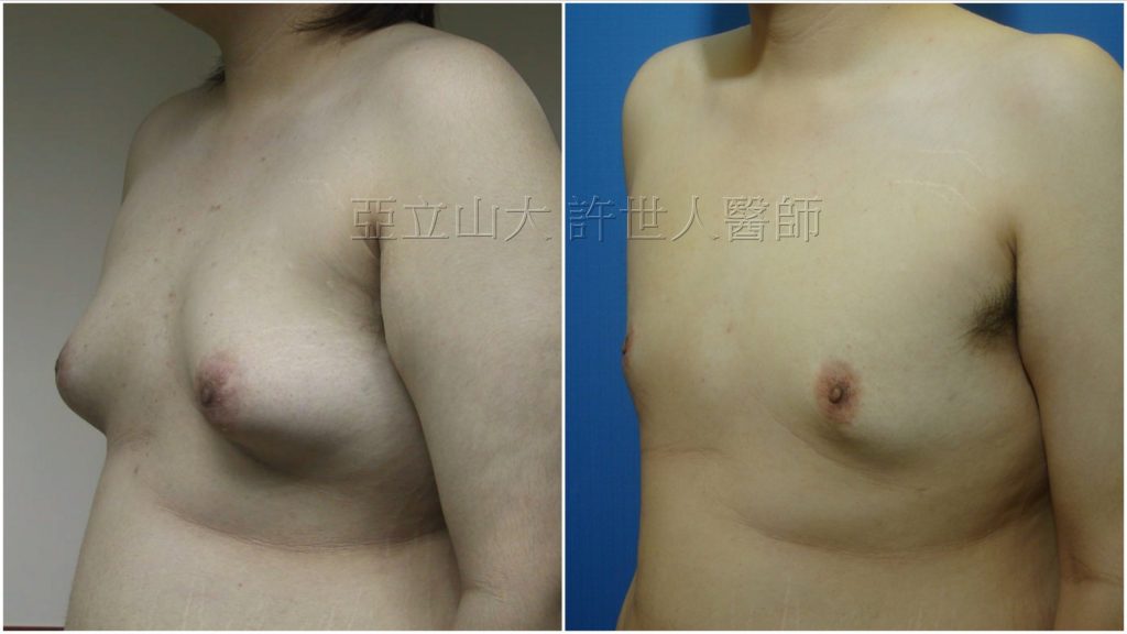 S__5808195浮a 男性女乳症手術案例