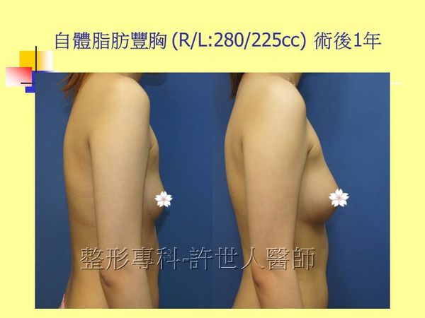 自體脂肪豐胸12