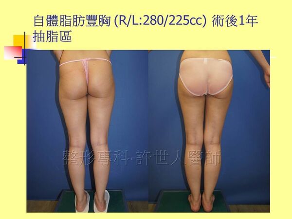 自體脂肪豐胸12