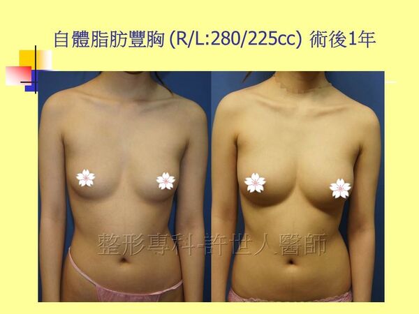 自體脂肪豐胸12