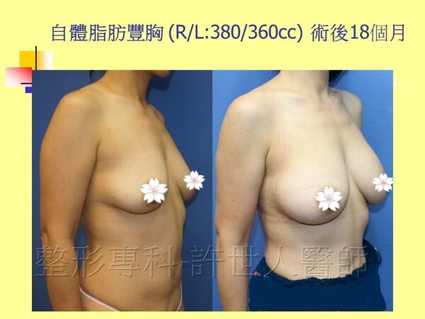 自體脂肪豐胸13