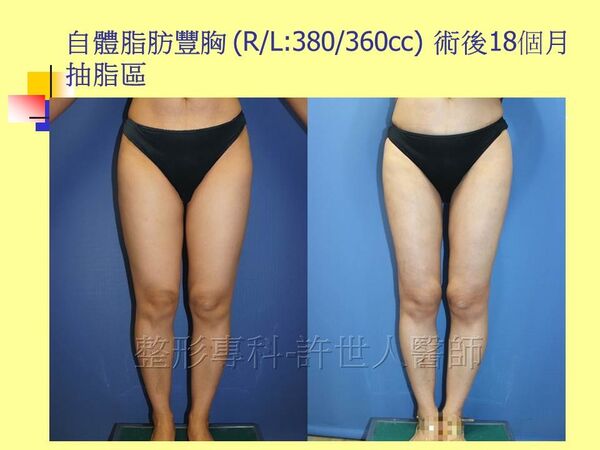 自體脂肪豐胸13