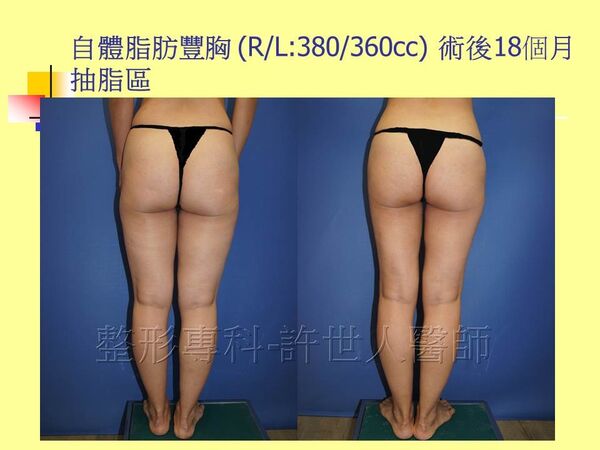 自體脂肪豐胸13