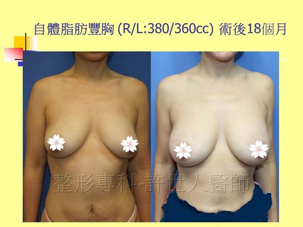 自體脂肪豐胸13
