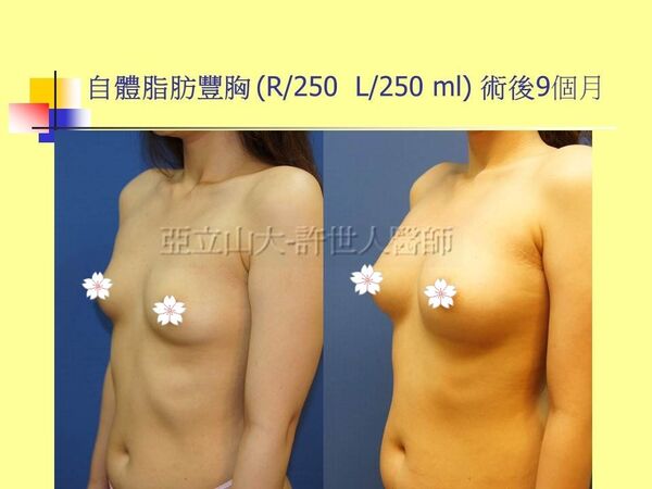 自體脂肪豐胸14