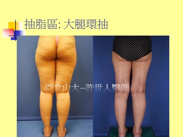 自體脂肪豐胸14