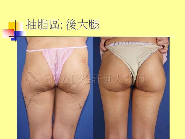 自體脂肪豐胸15