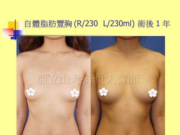 自體脂肪豐胸15