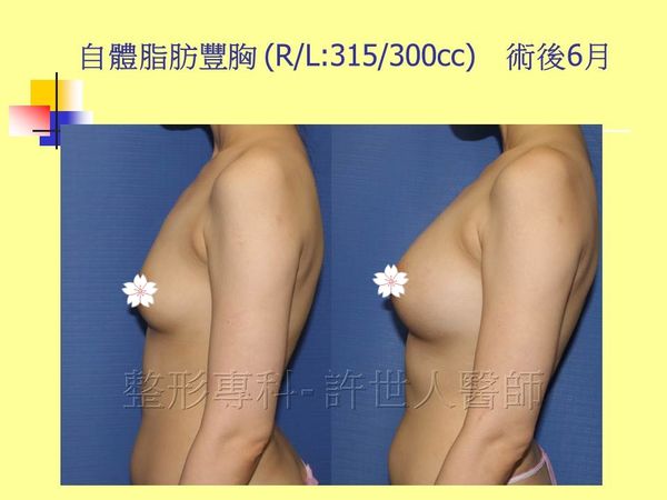 自體脂肪豐胸18