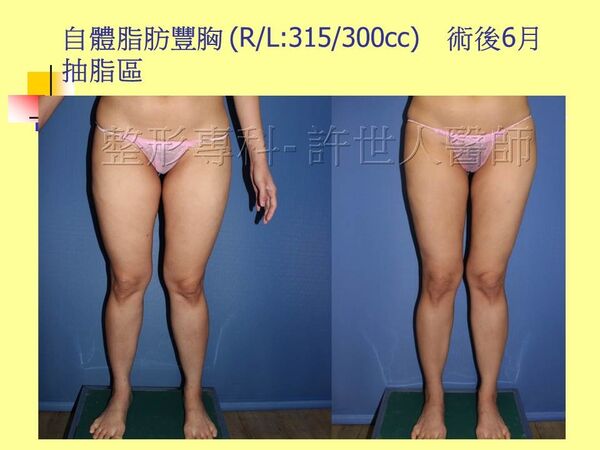 自體脂肪豐胸18