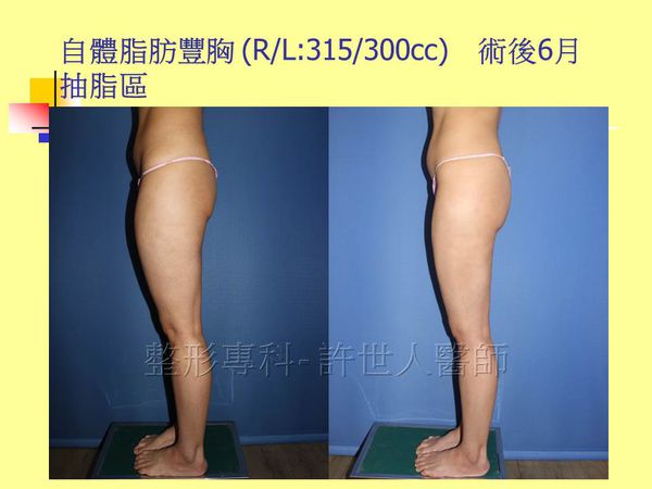 自體脂肪豐胸18