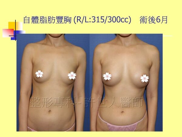 自體脂肪豐胸18