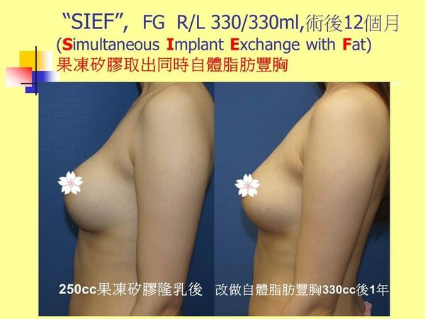 自體脂肪豐胸19