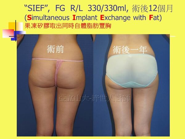 自體脂肪豐胸19