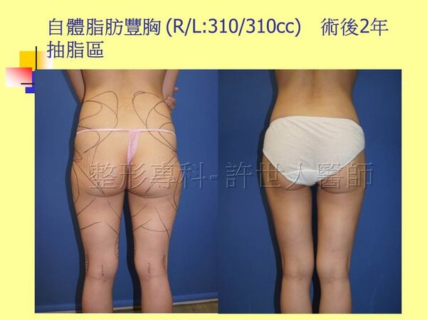 自體脂肪豐胸20 3