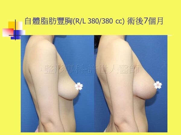 自體脂肪豐胸3