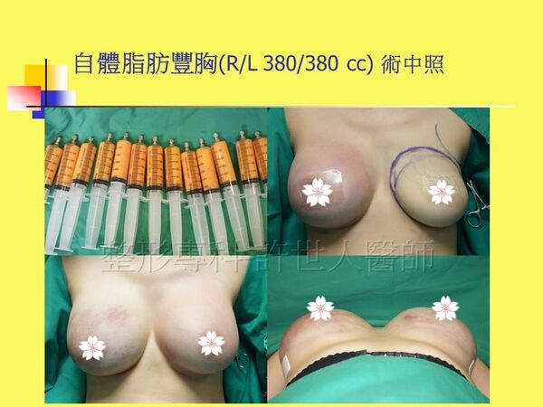 自體脂肪豐胸3