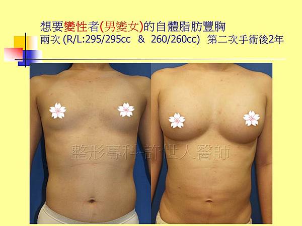 自體脂肪豐胸5