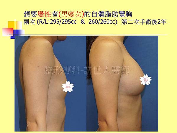 自體脂肪豐胸5