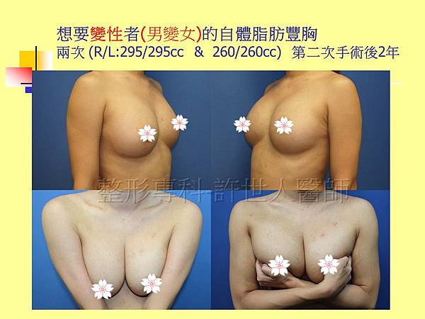 自體脂肪豐胸5