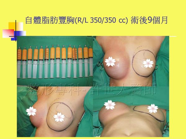 自體脂肪豐胸6