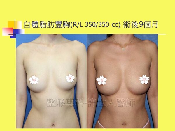 自體脂肪豐胸6