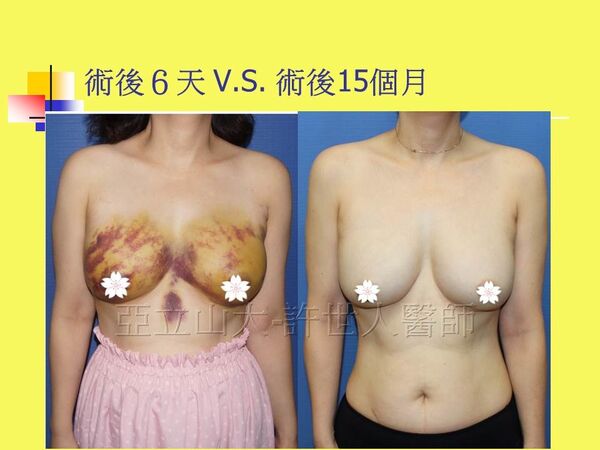 SIEF 自體脂肪隆乳豐胸