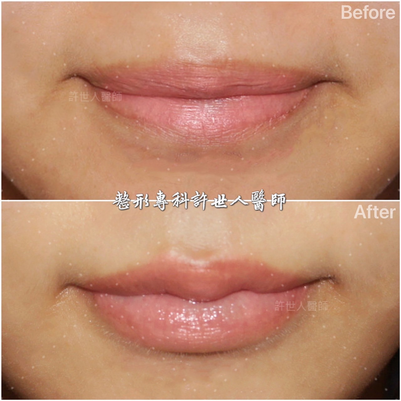 4D唇珠M形微笑唇整形術案例，術前術後呈現清晰M形唇峰與立體唇珠比例