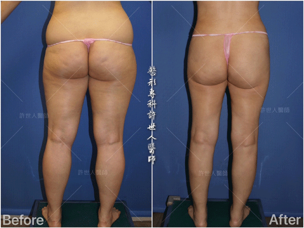 小腿抽脂 8 威塑VASER抽脂體雕案例 –全身多處+ 小腿
