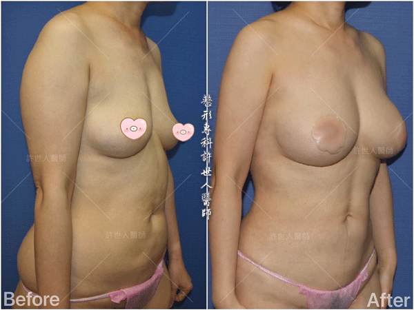 全身多處 15 全身威塑VASER抽脂體雕+自體脂肪隆乳